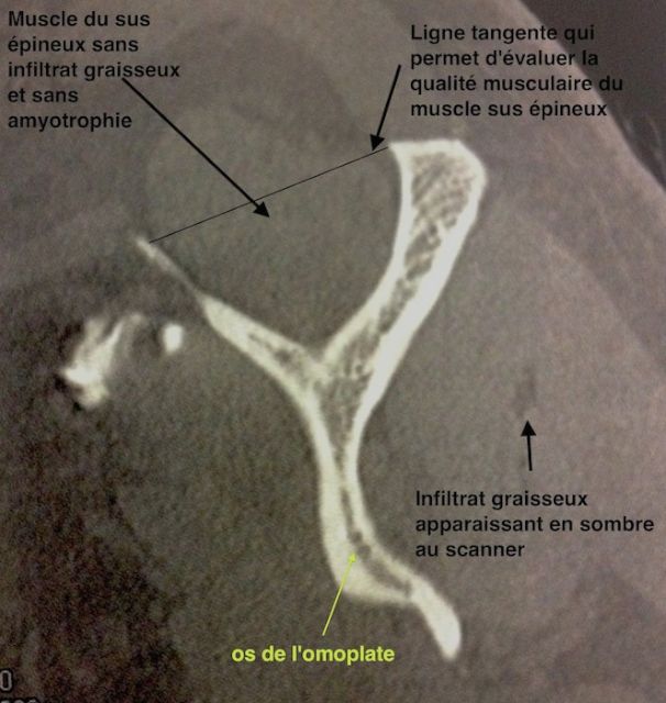 Vue sagitale (de profil) des muscles de la coiffe pour évaluer la
fonte musculaire (amyotrophie) et l'infiltrat graisseux à l'arthro-scanner
