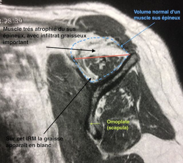 Vue sagitale (de profil) des muscles de la coiffe pour évaluer la
fonte musculaire (amyotrophie) et l'infiltrat graisseux à l'IRM