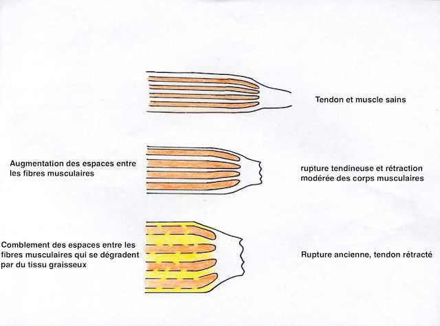 Evolution des fibres musculaires après rupture
et comblement de la perte de volume par de la graisse